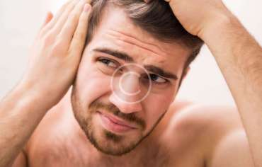 Going Bald Too Young? Top Tips From The Experts!